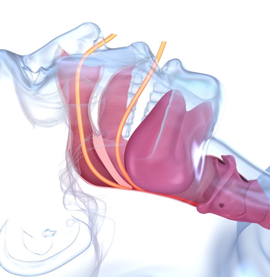 Illustration of person laying down with their airway blocked by throat tissues