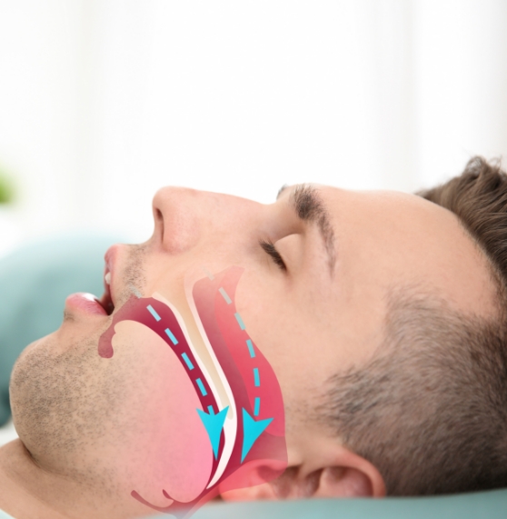 Sleeping person laying on their back with illustration of their blocked airway